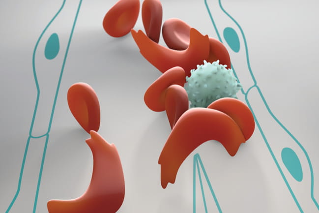 Illustration of Sickled Cells